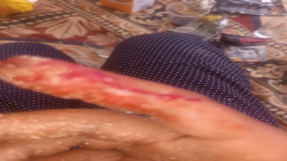 شاطئ الوطية : كلب ضال يهاجم اشخاص ويعضهم
